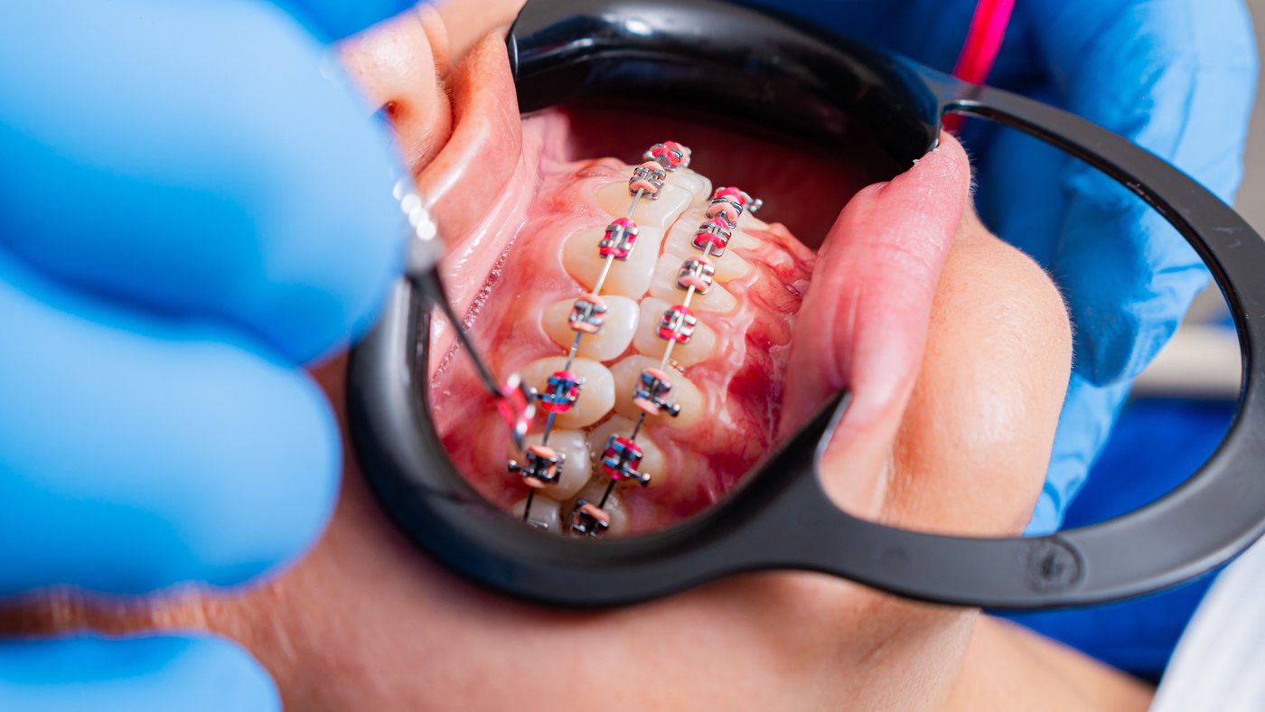 Orthodontic braces treatment close-up