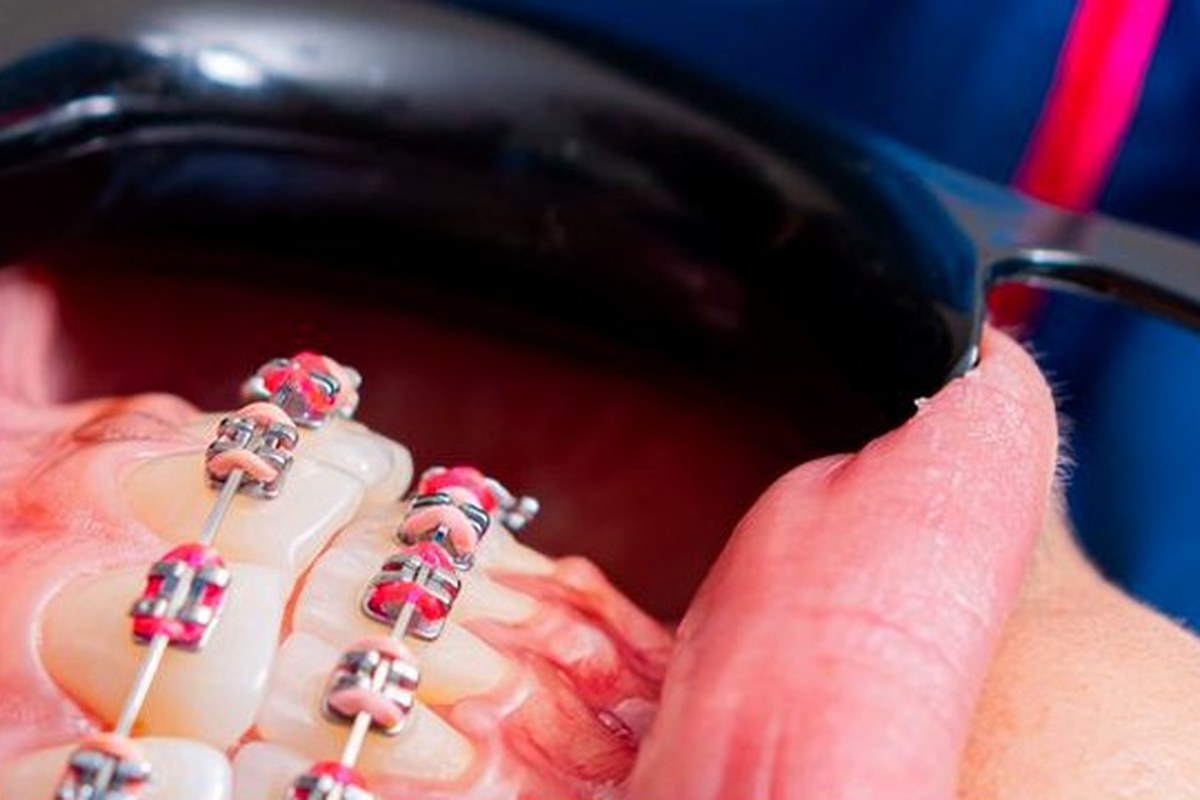 Crossbite Correction