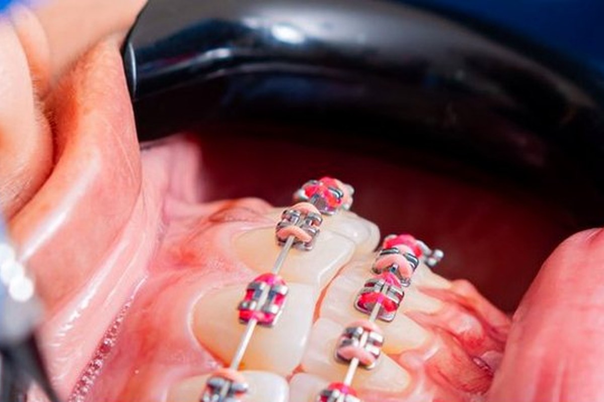 Metal Braces
