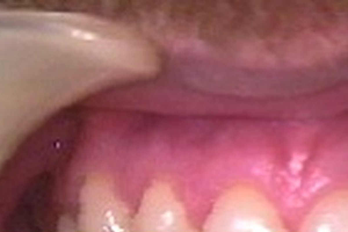 Retainers