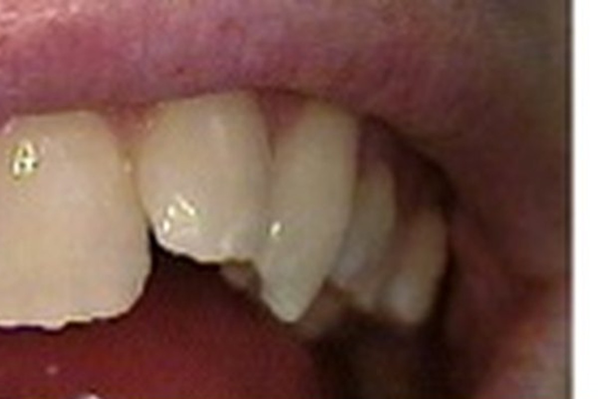 Self-Ligating Braces